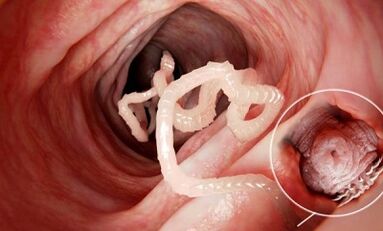 Comment reconnaître la présence de parasites dans l'intestin humain