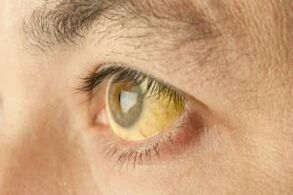 Jaunissement du blanc des yeux